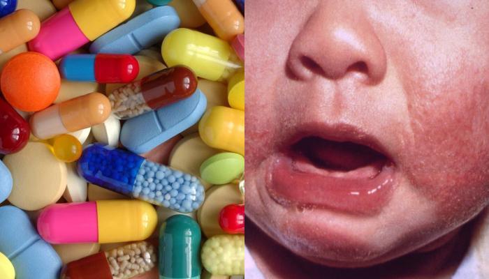 Τα 4 φάρμακα που προκαλούν τις πιο συχνές φαρμακευτικές αλλεργίες