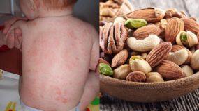 Πως θα καταλάβεις ότι το παιδί έχει αλλεργία στους ξηρούς καρπούς;-Διάγνωση και αντιμετώπιση