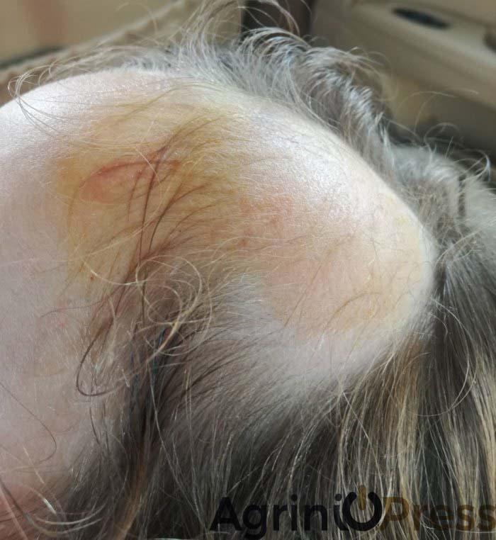 Πεντάχρονη σφήνωσε σε κούνια παιδικού σταθμού και ξεριζώθηκαν τα μαλλιά της