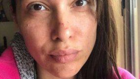 H Κλέλια Ρένεση με γρατσουνιές στο πρόσωπο: Το μήνυμα και η εξήγησή της