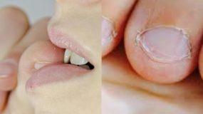 Τρώτε τα νύχια σας; Δείτε 10 τρόπους να κόψετε αυτή την κακή συνήθεια ΆΜΕΣΑ!
