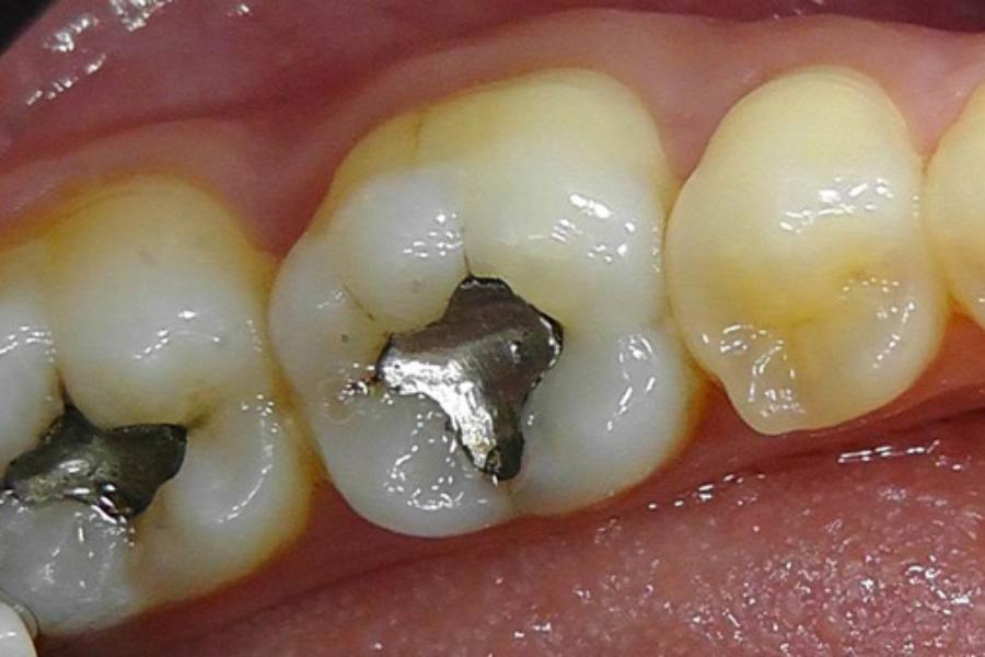 Τα μαύρα σφραγίσματα στα δόντια πρέπει να αντικατασταθούν! Ποια επικίνδυνη ουσία περιέχουν;