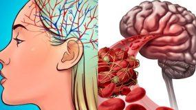Τι είναι η εγκεφαλική εμβολή; Τα 6 ανησυχητικά συμπτώματα, οι κίνδυνοι & οι τρόποι θεραπείας