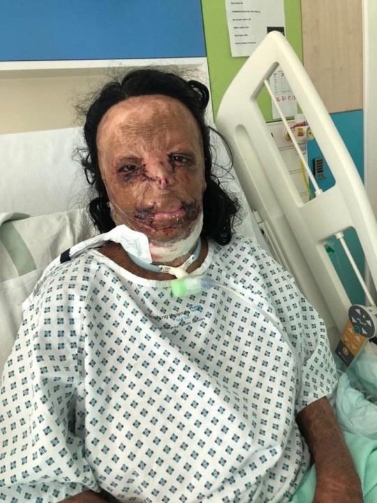 Η Aleema Ali μετά το ατύχημα με το φάρμακο για τις ψείρες 