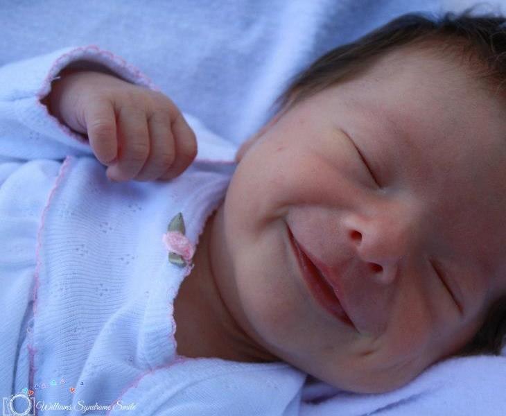 μωρό με σύνδρομο Williams 