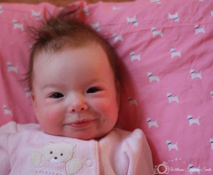 μωρό με σύνδρομο Williams 