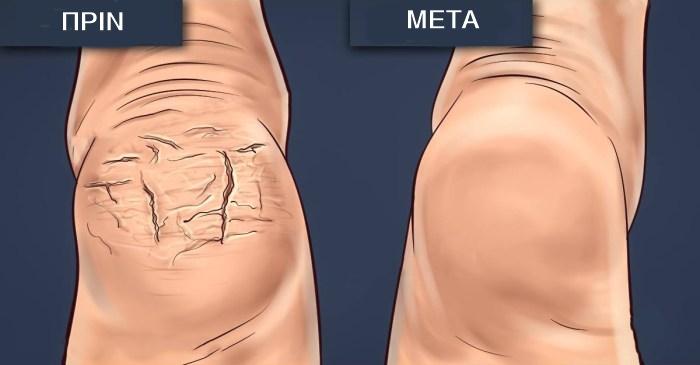 αντιμετωπίζουμε τις σκασμένες φτέρνες με το vicks 