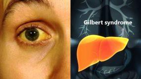 Σύνδρομο Gilbert: Ποια είναι τα συμπτώματα & πως γίνεται η διάγνωση