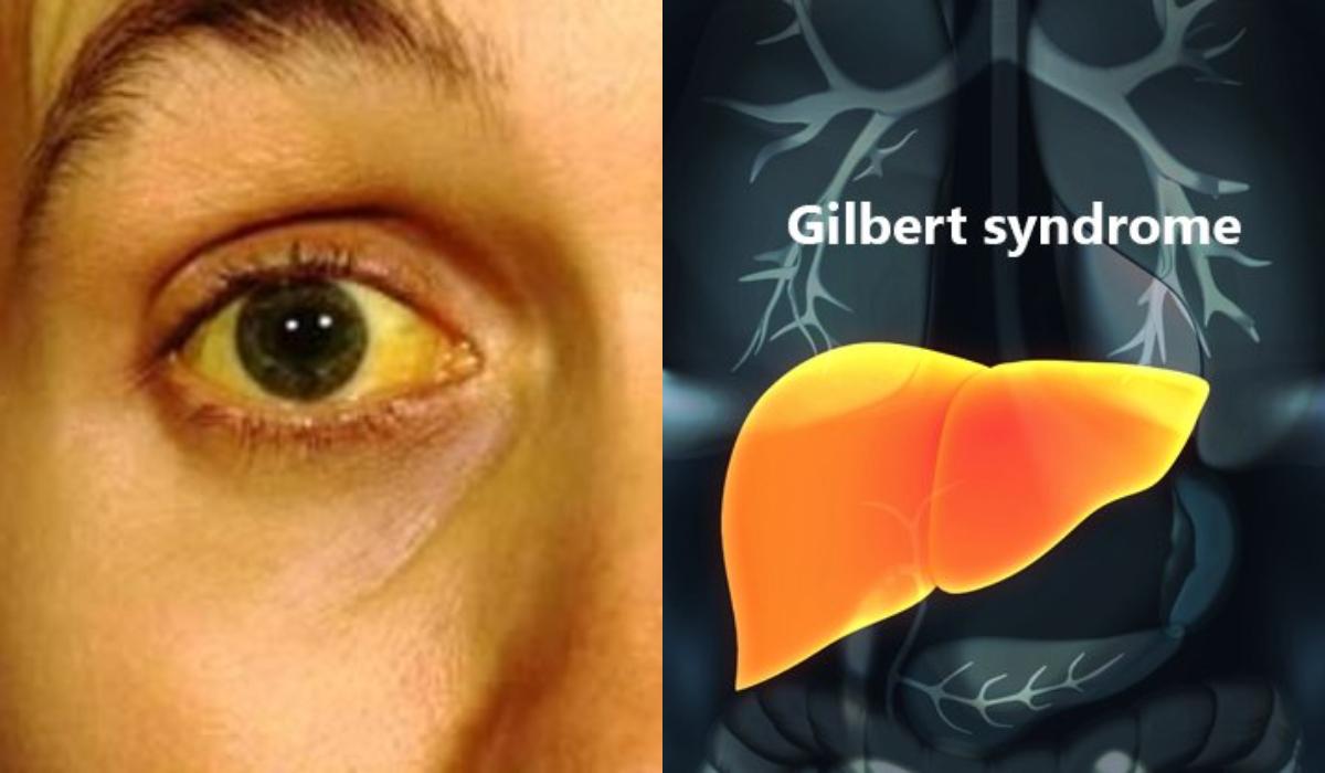 Σύνδρομο Gilbert: Ποια είναι τα συμπτώματα & πως γίνεται η διάγνωση