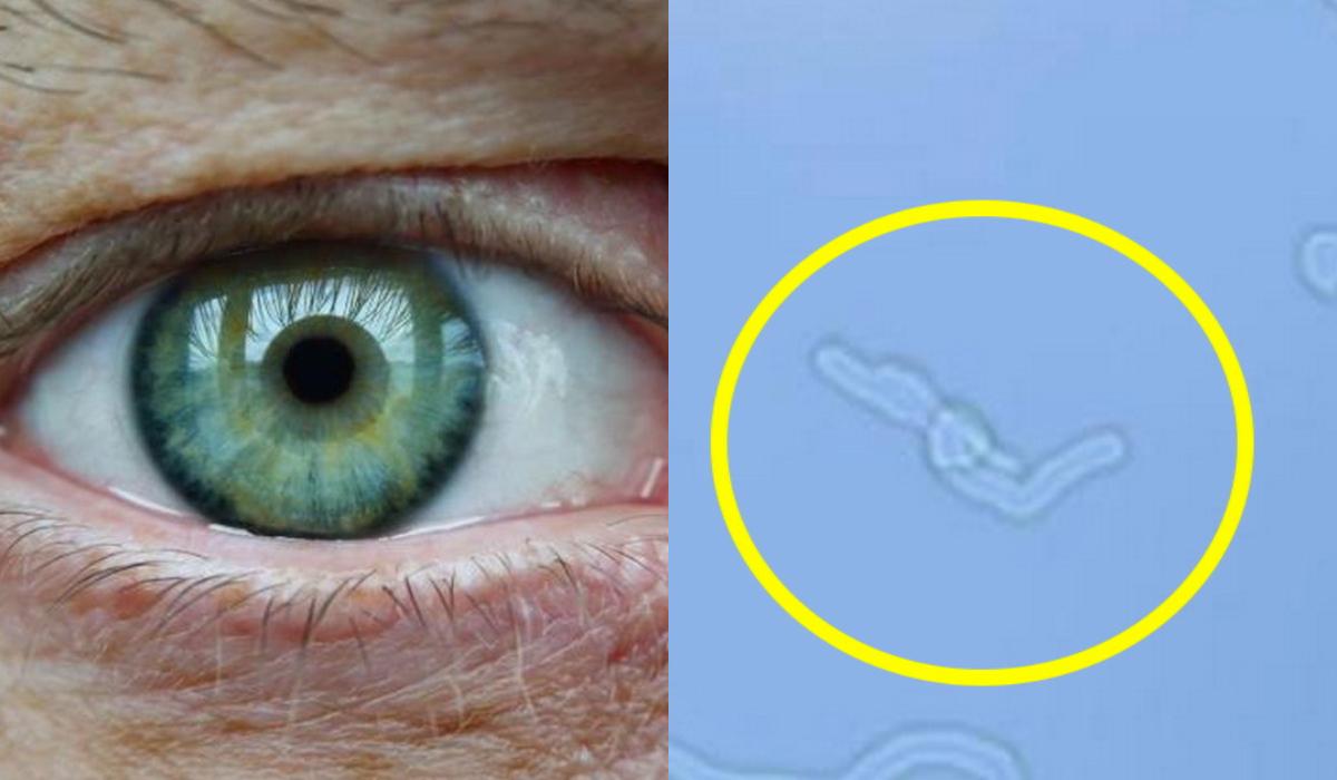 Γιατί βλέπουμε “κηλίδες” ή “μυγάκια” στα μάτια μας; Πόσο επικίνδυνο μπορεί να είναι;