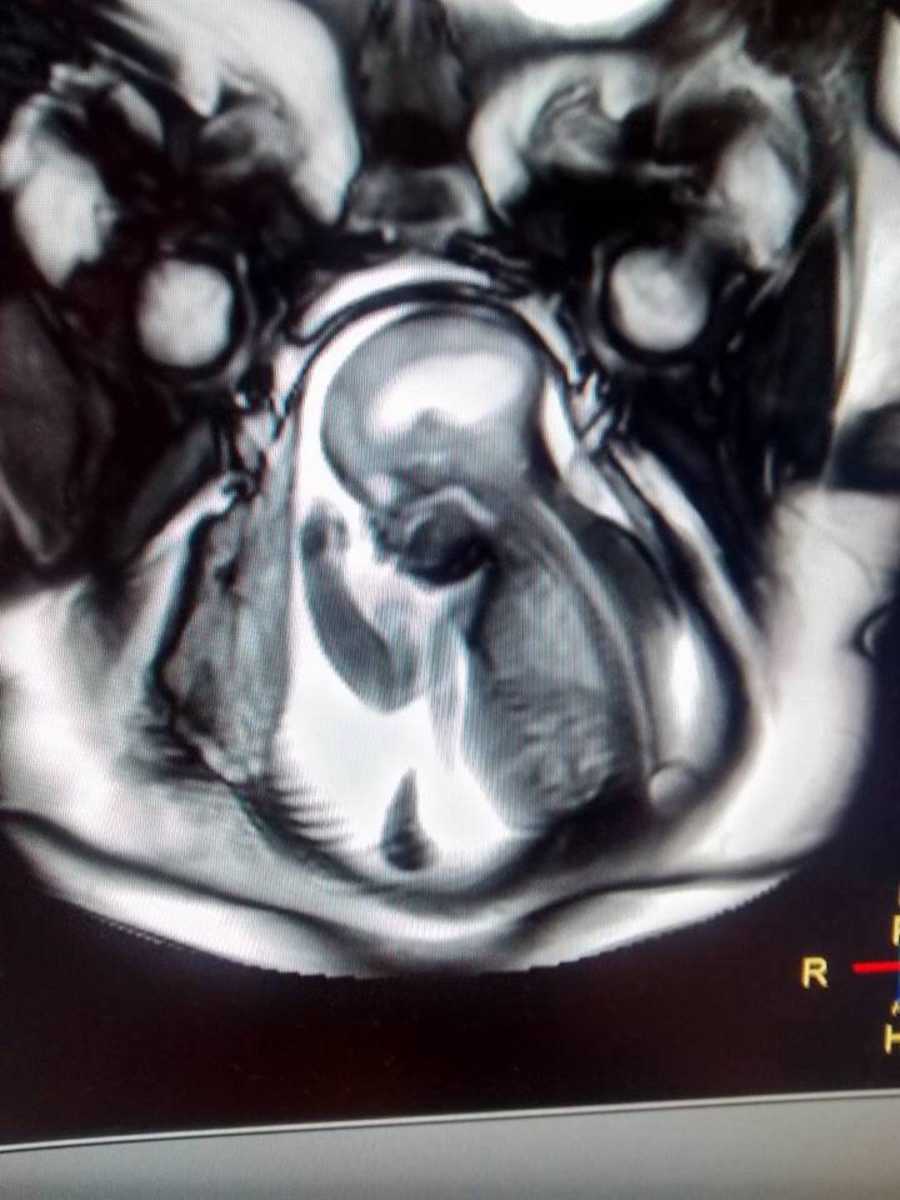 Υπέρηχος εμβρύου_