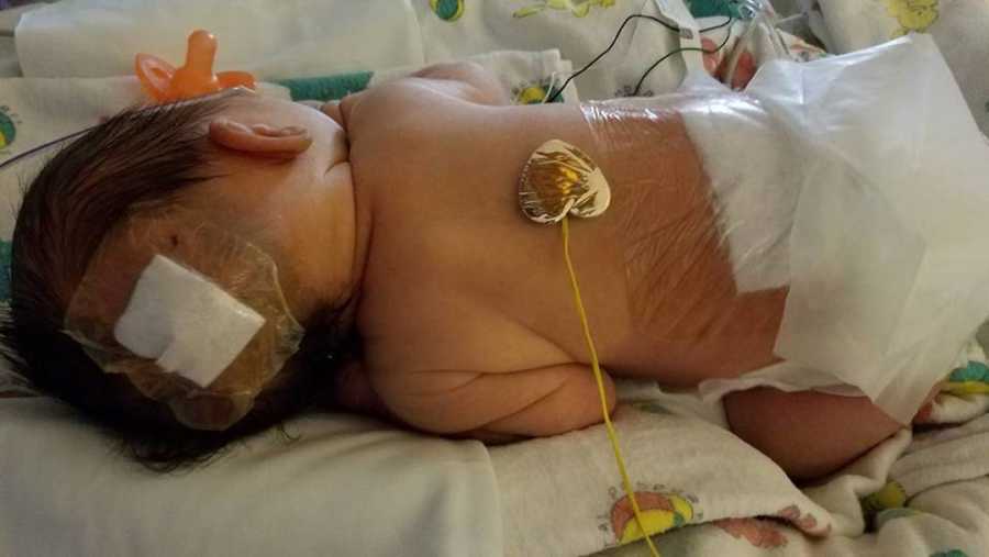 δισχιδής ράχη_