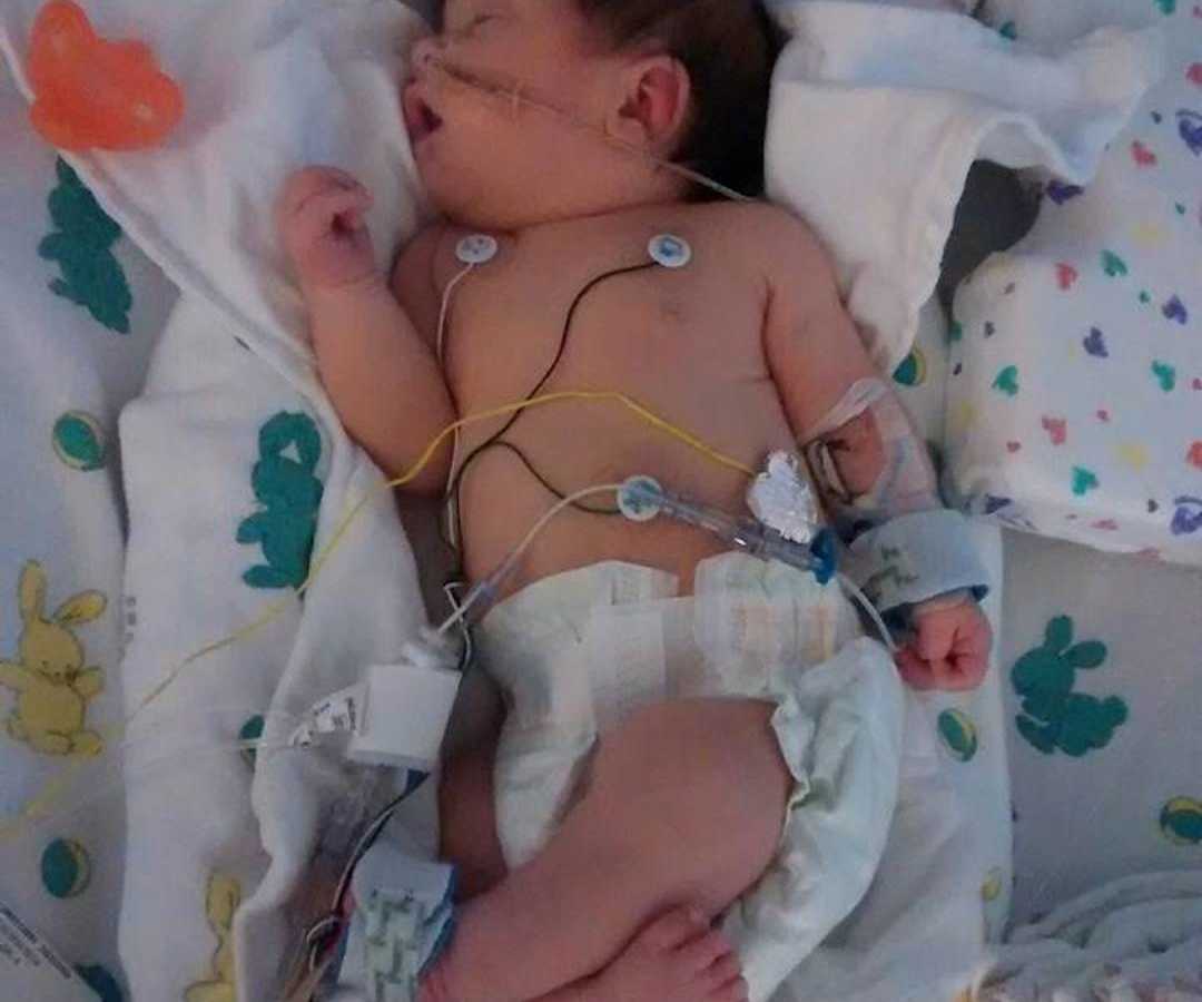 Μωρό_ με_ Spina bifida_