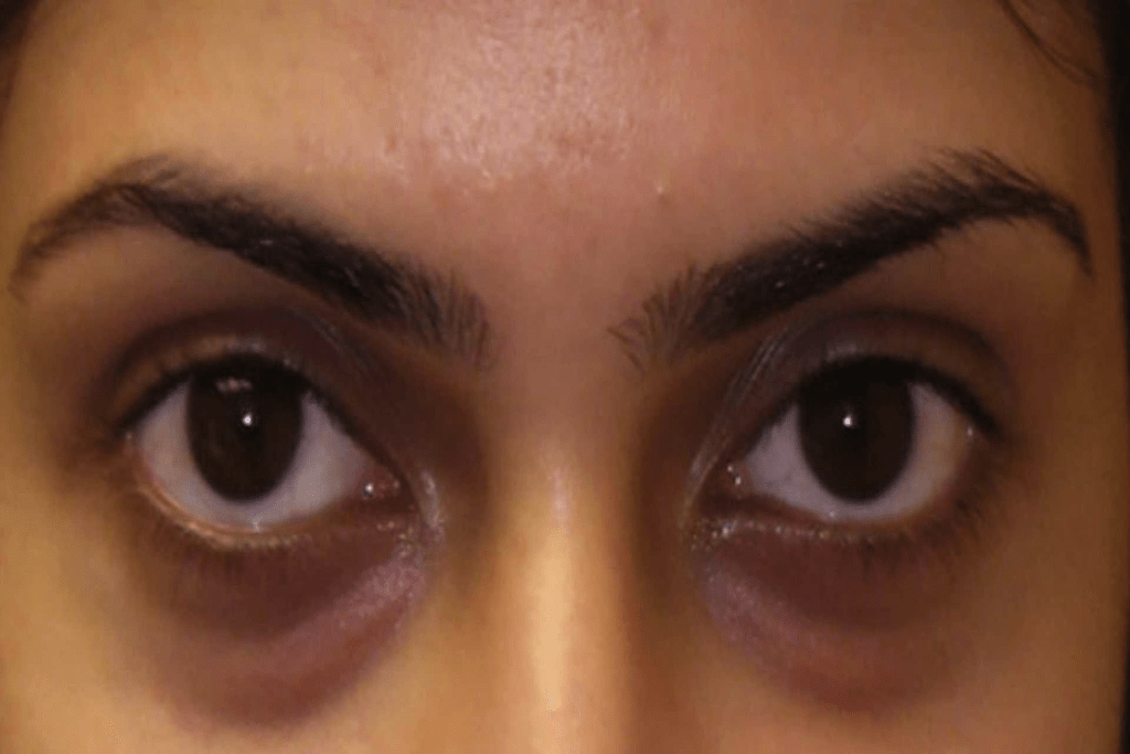 Σπιτική συνταγή για να διώξετε μαύρους κύκλους και σακούλες