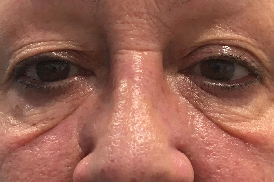 Σπιτική συνταγή για να διώξετε μαύρους κύκλους και σακούλες