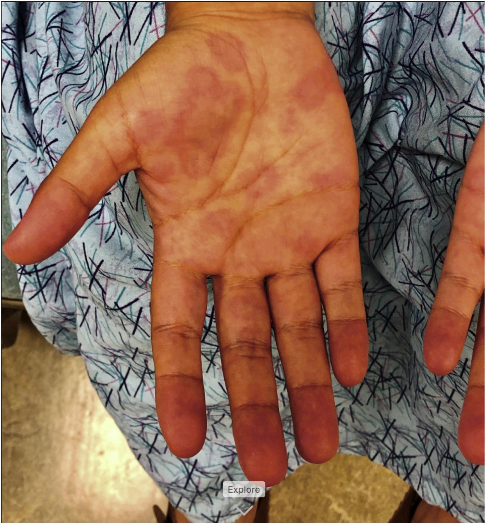 Πολυσυστημικό φλεγμονώδες σύνδρομο: Συμπτώματα στο παιδί