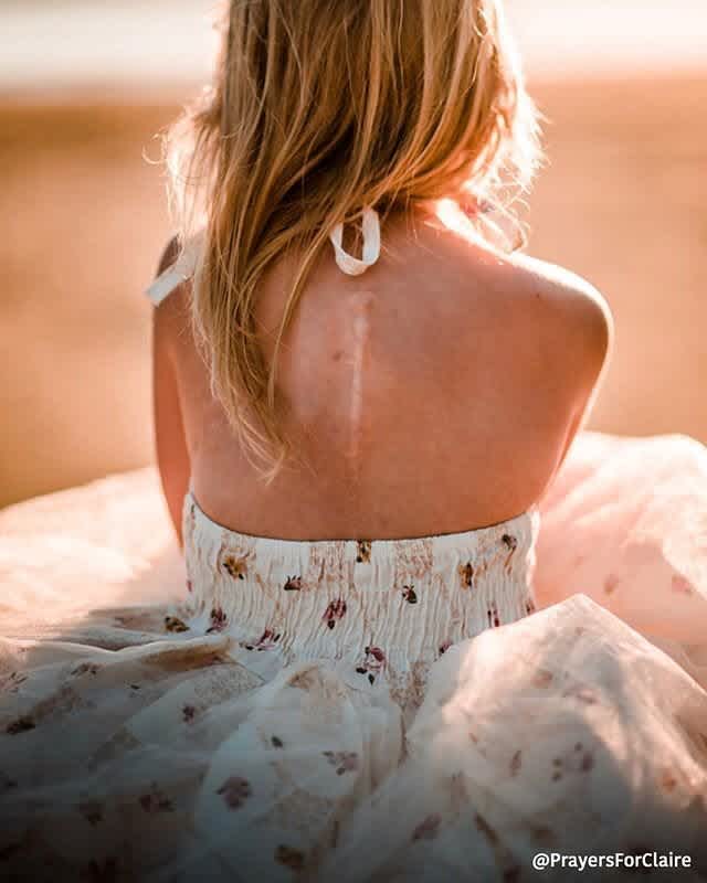 Ένα_ αγòρι _μου _είπε_ να_ μην_ φοράω_ μπλουζάκια_ που _δείχνουν_ τις -ουλές_ μου_ από_ καρκίνο_ γιατί_ τρομάζει_ - Το_ συγκινητικό_ γράμμα_ μητέρας_