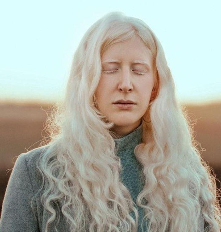 συγκλονιστικές φωτογραφίες_με_ανθρώπους_με_αλμπινισμό_