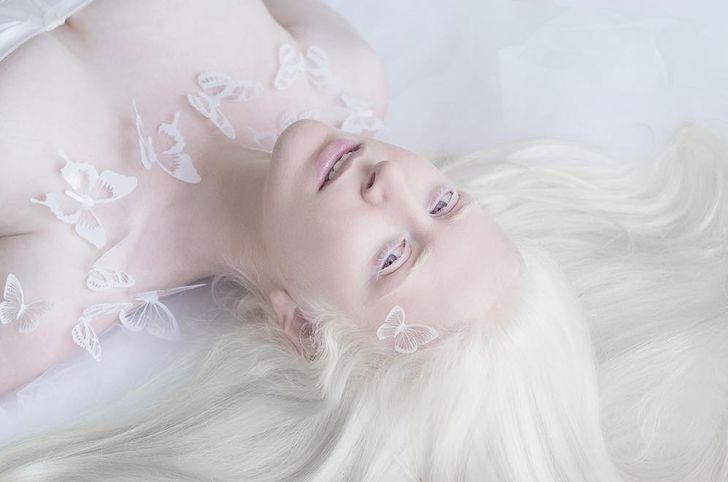 συγκλονιστικές φωτογραφίες_με_ανθρώπους_με_αλμπινισμό_