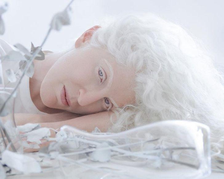 συγκλονιστικές φωτογραφίες_με_ανθρώπους_με_αλμπινισμό_