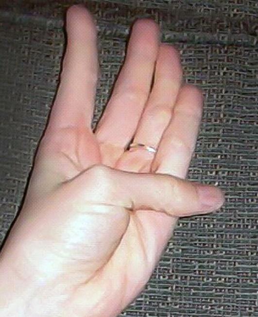 Το τεστ του αντίχειρα δείχνει ένα σοβαρό πρόβλημα υγείας