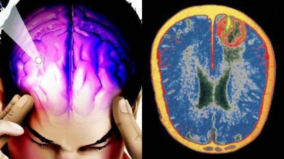 Εγκεφαλίτιδα: Τα συμπτώματα , η πρόληψη και η θεραπεία_
