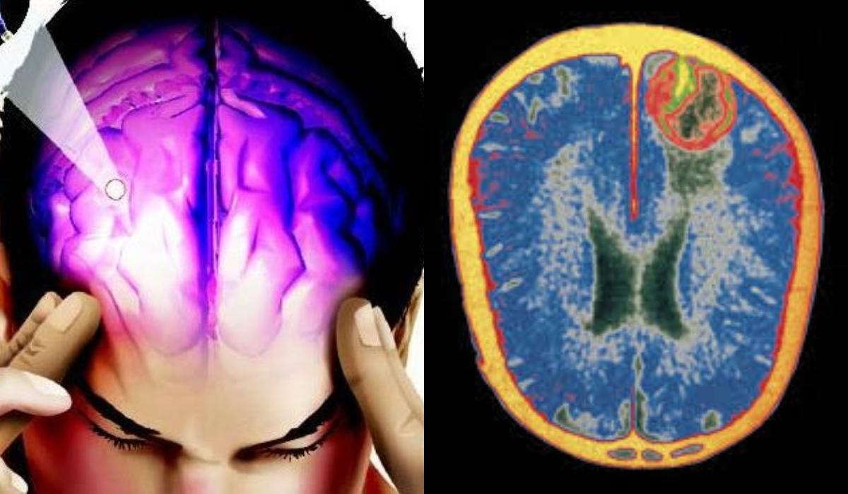 Εγκεφαλίτιδα: Τα συμπτώματα , η πρόληψη και η θεραπεία_
