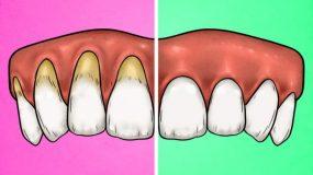 4 σημάδια ότι βουρτσίζετε τα δόντια σας λάθος και οι σωστοί τρόποι να το διορθώσετε_
