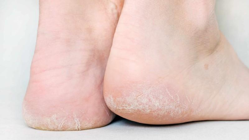 Το έξυπνο κόλπο για να αντιμετωπίσετε τις σκασμένες φτέρνες