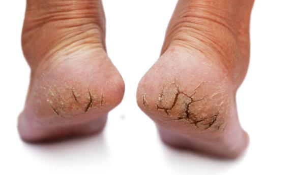 Το έξυπνο κόλπο για να αντιμετωπίσετε τις σκασμένες φτέρνες