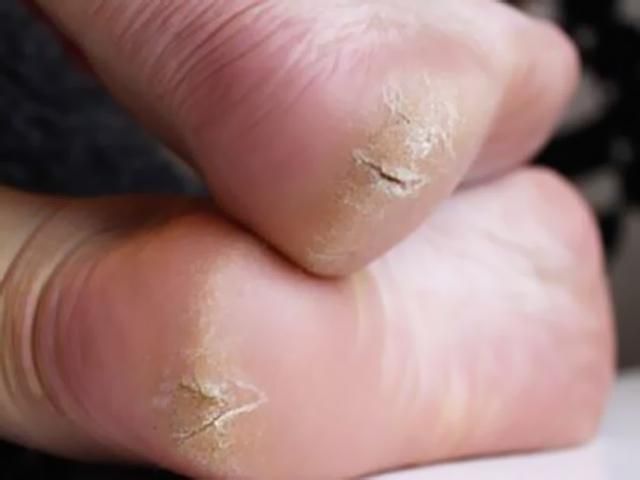 Το έξυπνο κόλπο για να αντιμετωπίσετε τις σκασμένες φτέρνες