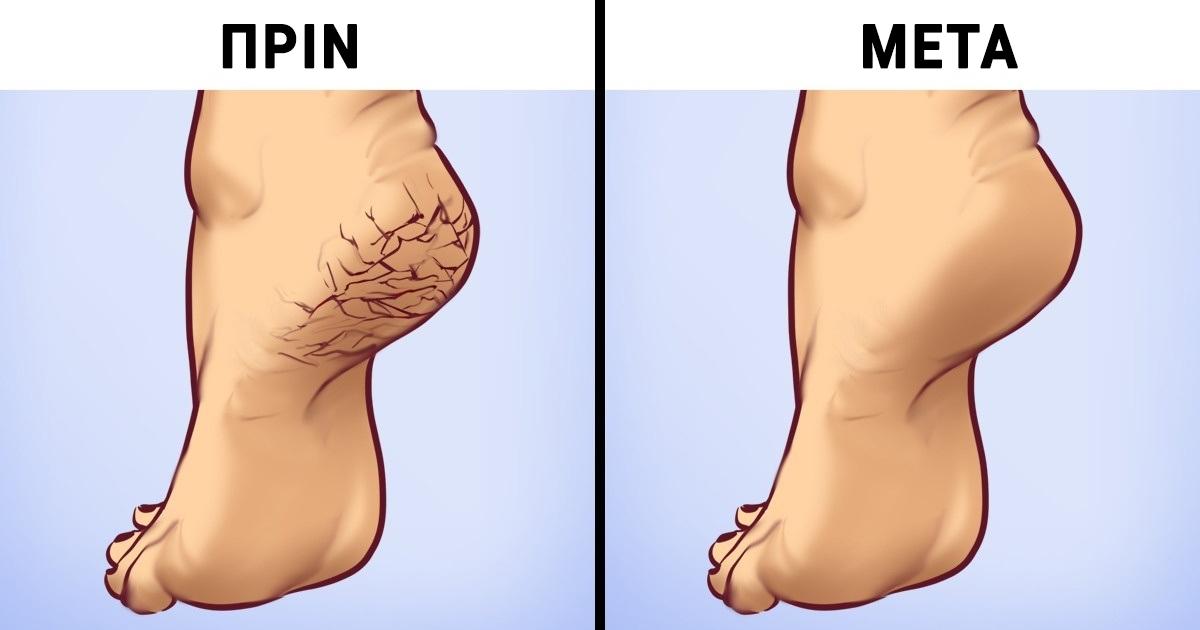 Το έξυπνο κόλπο για να αντιμετωπίσετε τις σκασμένες φτέρνες