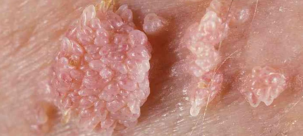 Τελικά κολλάει ο ιός HPV με τα χέρια;