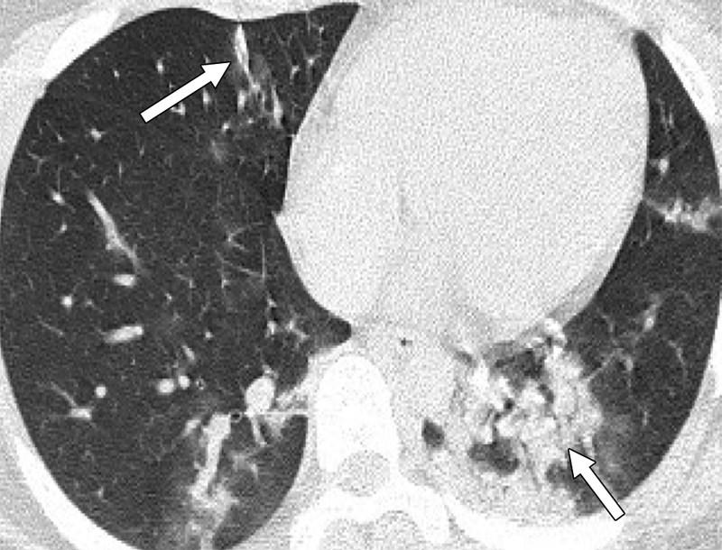 Δείτε τους πνεύμονες ανηλίκων που νόσησαν με κορονοϊό – Συγκλονιστικές εικόνες