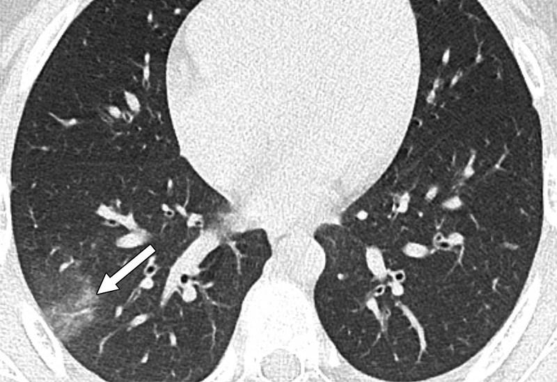 Δείτε τους πνεύμονες ανηλίκων που νόσησαν με κορονοϊό – Συγκλονιστικές εικόνες