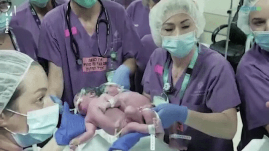 βρέφη σιαμαία_χωρίστηκαν_και_κοιτάχτηκαν_για_πρώτη_φορά_