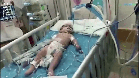 βρέφη σιαμαία_χωρίστηκαν_και_κοιτάχτηκαν_για_πρώτη_φορά_