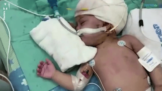 βρέφη σιαμαία_χωρίστηκαν_και_κοιτάχτηκαν_για_πρώτη_φορά_