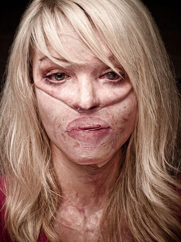 Οι επιθέσεις με βιτριόλι στην Ελλάδα: Από την Κωνσταντίνα Κούνεβα στην Ιωάννα Παλιοσπύρου