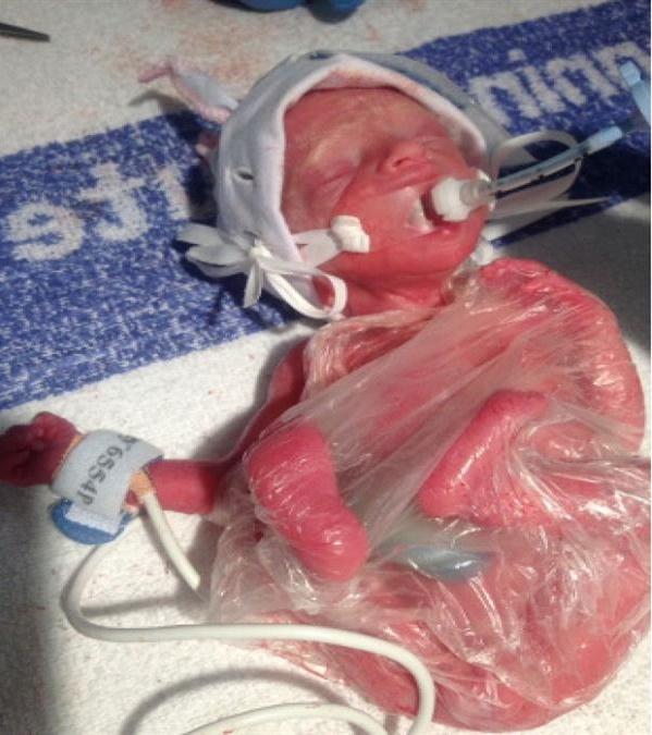 Βρέφος-γεννήθηκε-μόλις-600 γρ.-πλέον-είναι-4-χρονών-και-πάει-πρώτη-φορά-σχολείο-