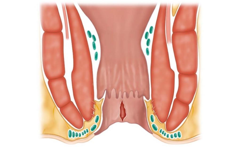 Ραγάδα Δακτυλίου-παιδι Ραγάδα Δακτυλίου- παιδί