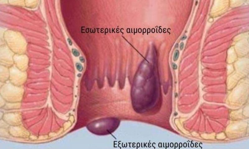 Πρωκτός: Όλες οι παθήσεις που μπορεί να προσβληθεί ένα παιδί