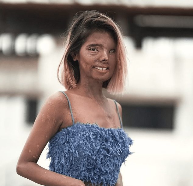 της-έριξε-οξύ-ο-πατέρας-της-και-πλέον-είναι-μοντέλο-ιστορία-