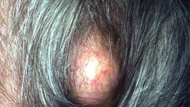 Σπυράκια στο κεφάλι: Δείτε όλες τις πιθανές αιτίες