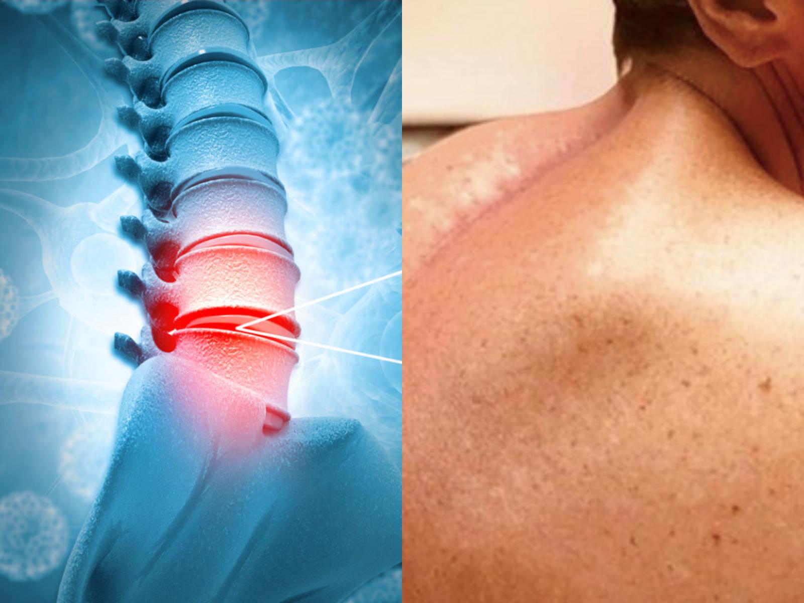 Χόρδωμα-: Συμπτώματα -και- αντιμετώπιση-