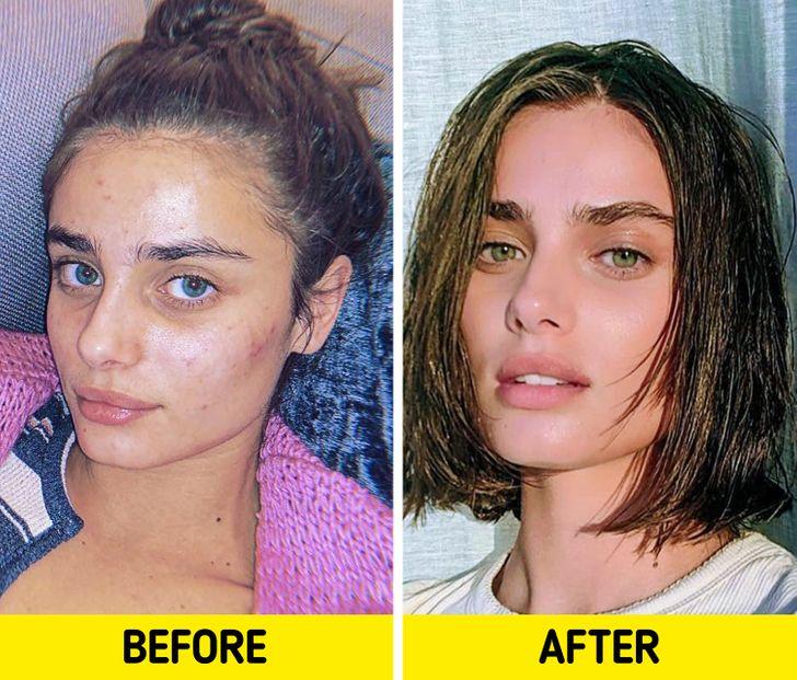 6-φυσικοί-τρόποι-για-να-διώξετε-τα-σπυράκια-