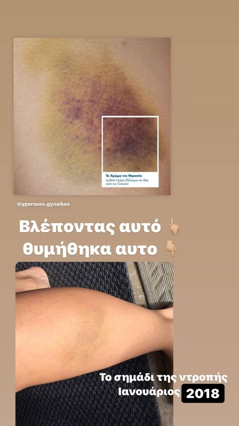 Συγκλονίζει η Σοφία Παυλίδου : Το σημάδι της ντροπής από τον ξυλοδαρμό που είχε δεχθεί – Εικονα