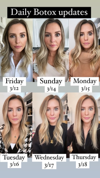 μπότοξ-μπλόγκερ-έκανε-αποτυχημένο μπότοξ-και-μοιράστηκε-την-εμπειρία-της- μπότοξ-μπλόγκερ-έκανε-αποτυχημένο μπότοξ-και-μοιράστηκε-την-εμπειρία-της-