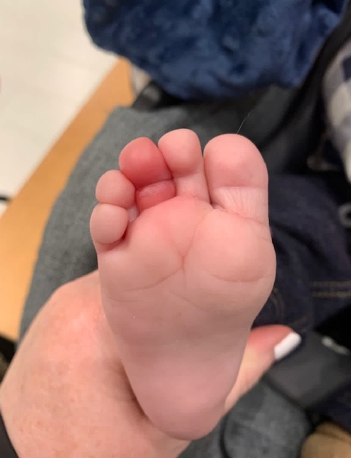 μωρό-παραλίγο-να-χάσει-το-δάχτυλό-του-από-μία-τρίχα-