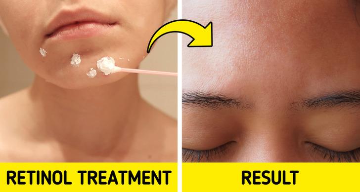 μικρά-λευκά σπυράκια-στο-πρόσωπο-και-πως-αντιμετωπίζονται-